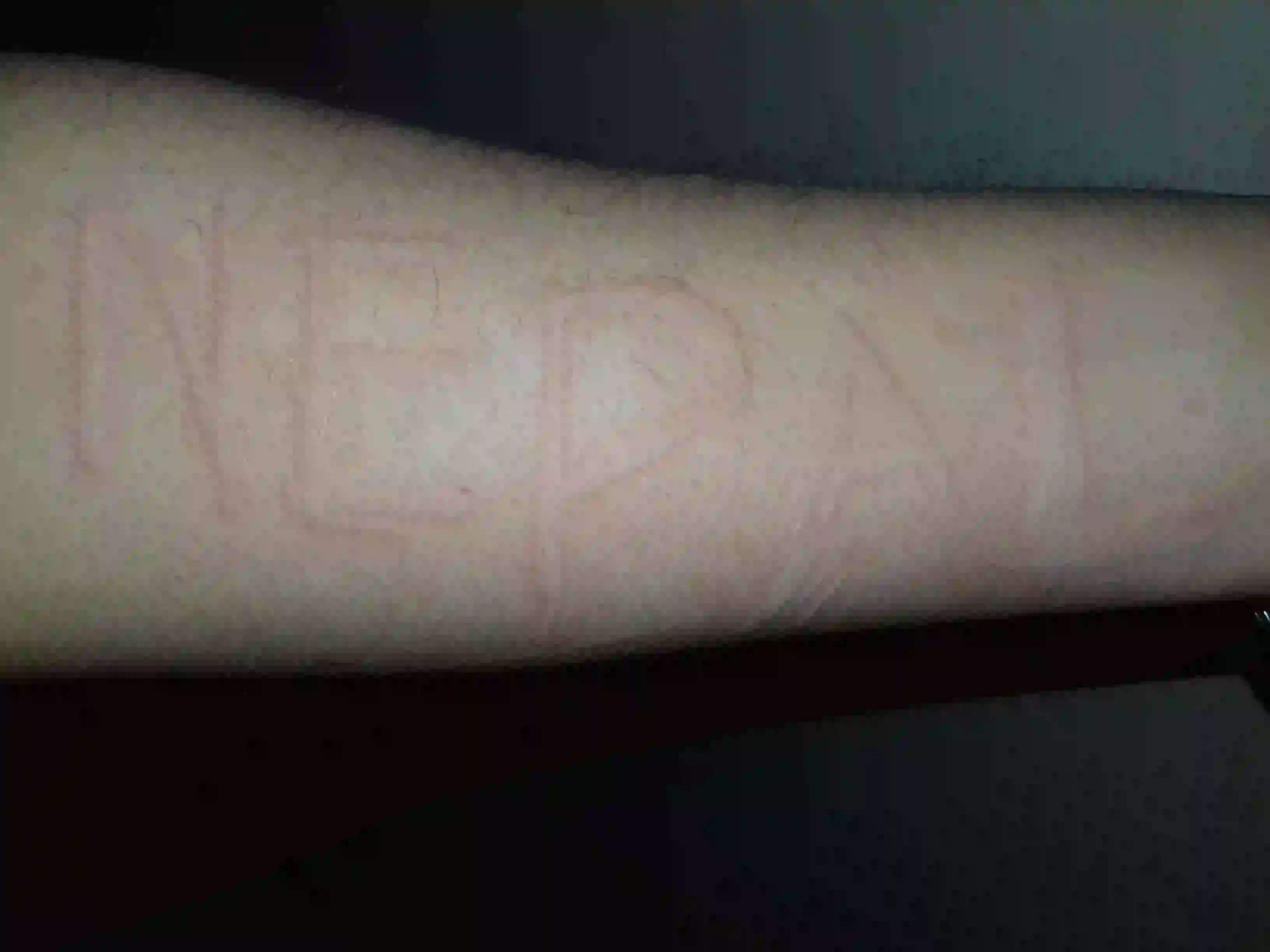 dermatographia-cause-symptoms-cures-prevention-science-behind-it